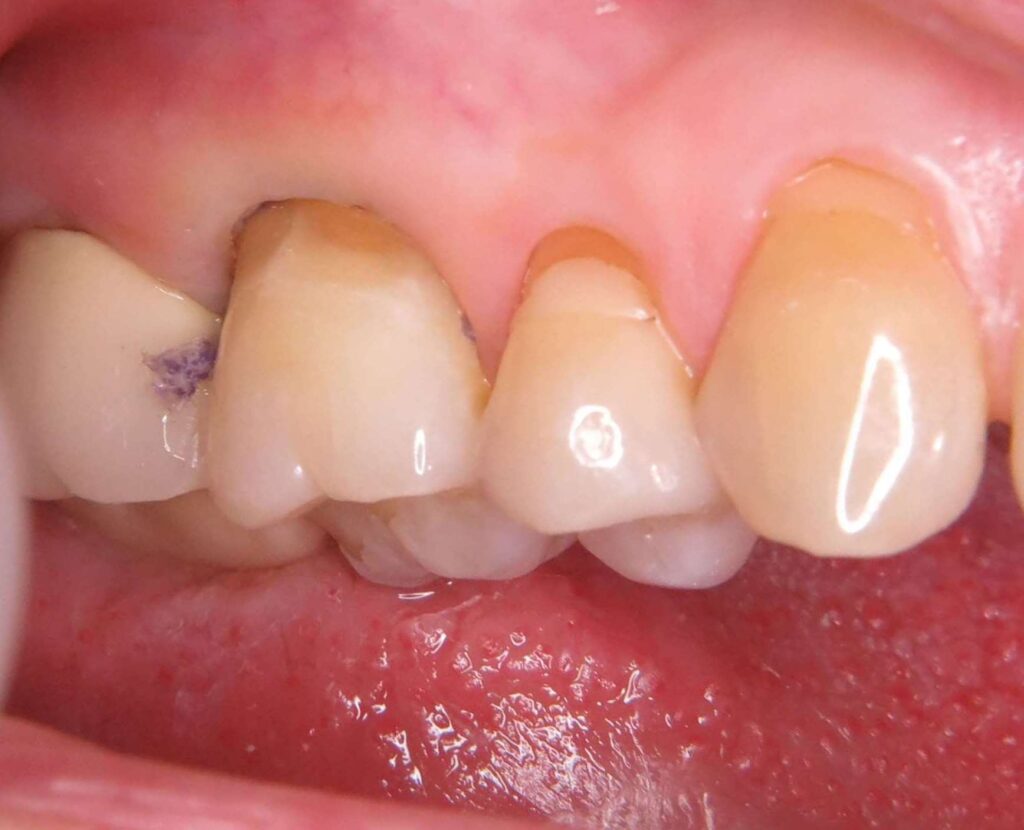 A fogínysorvadás kezelése többlépcsős folyamat