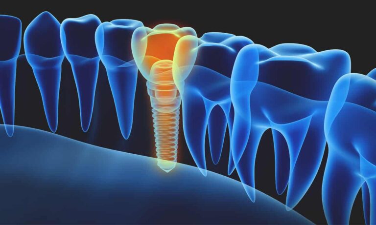 Foghúzás után mikor kell elvégezni a fogimplantációt?