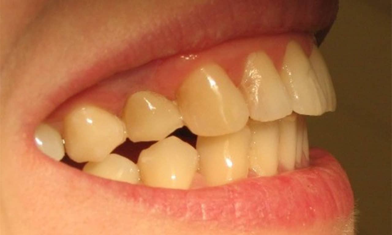 Csiszolás nélküli fogimplantátum