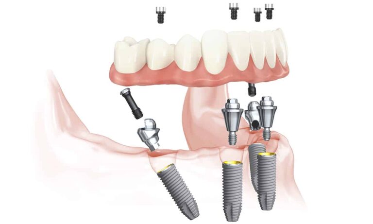 A fogászati implantátum legnagyobb előnyei