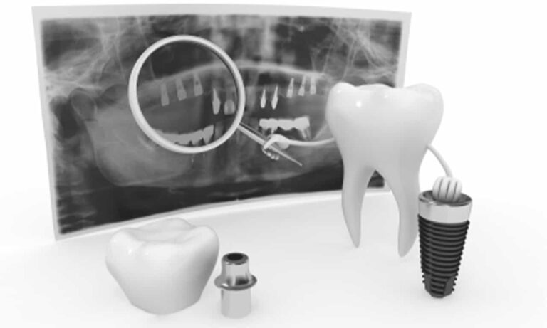 Mini implantátummal rögzített fogsor tervezése