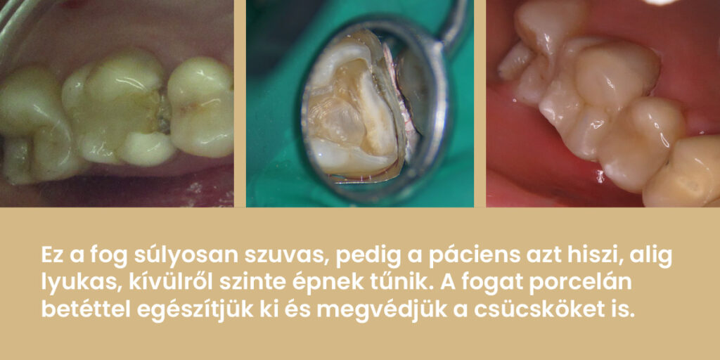 Ez a fog súlyosan szuvas, pedig a páciens azt hiszi, alig lyukas, kívülről szinte épnek tűnik. A fogat porcelán betéttel egészítjük ki és megvédjük a csücsköket is.