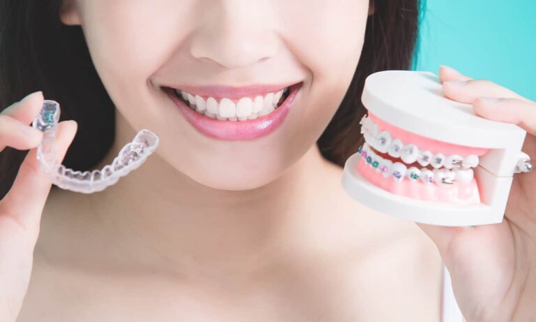 Fix fogszabályozó készülékek összehasonlítása