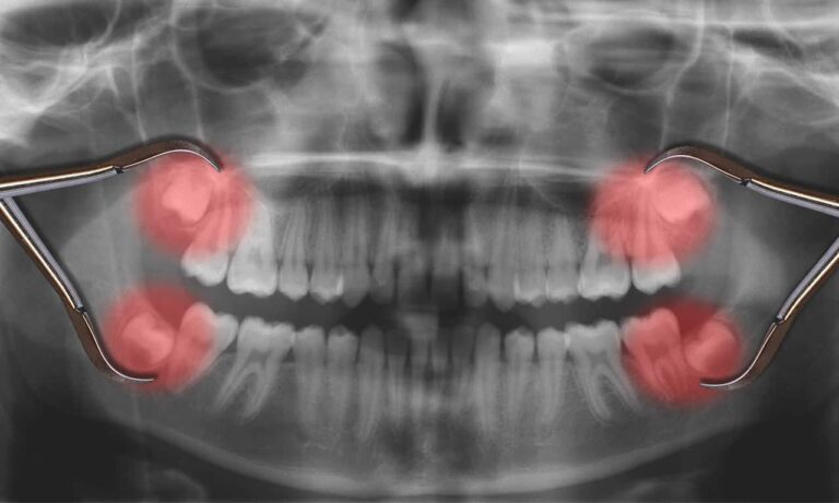 Hogyan húzunk fogat fájdalmak nélkül