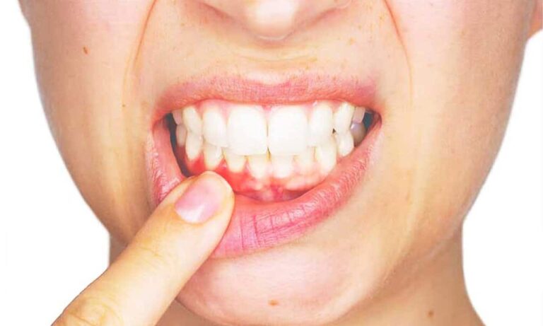 A fogínysorvadás előbb utóbb a fogak elvesztéséhez vezet