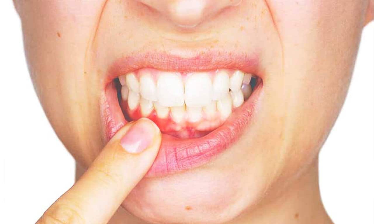 A fogínysorvadás előbb utóbb a fogak elvesztéséhez vezet