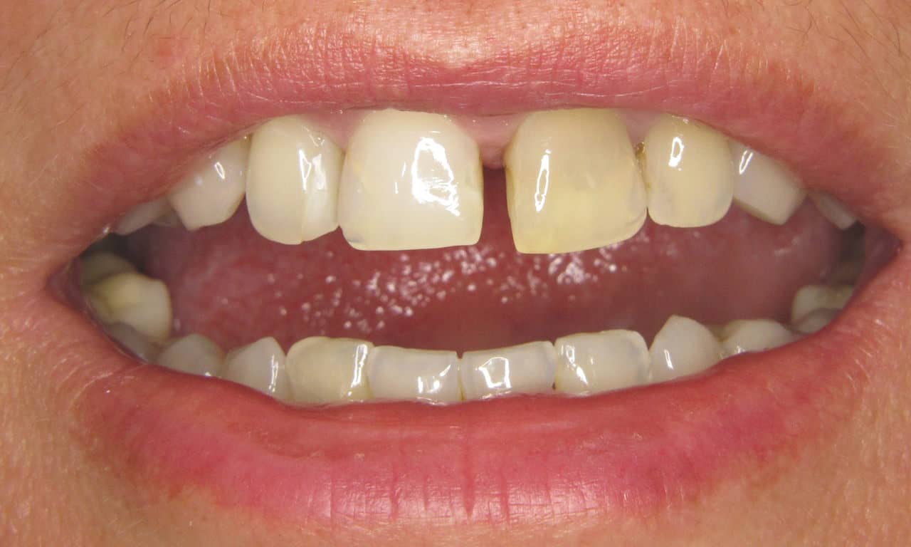 Felső fogak közti hézag eltüntetésének lehetőségei