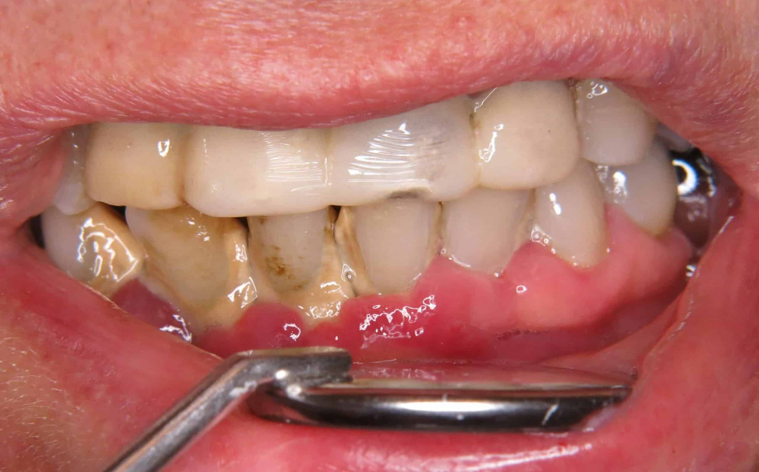 A súlyos fogínysorvadás kezelése fogkőeltávolítással kezdődik
