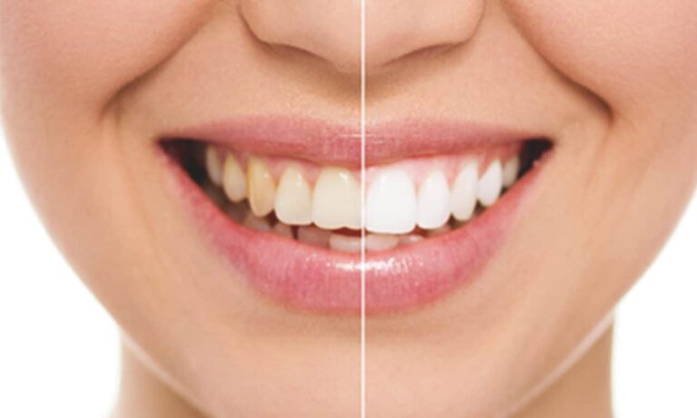 Fehérebb fogakat szeretnék – a legnépszerűbb fogfehérítési módszerek